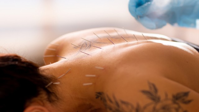 Acupuncturist inserts an acupuncture needle into a woman's back.